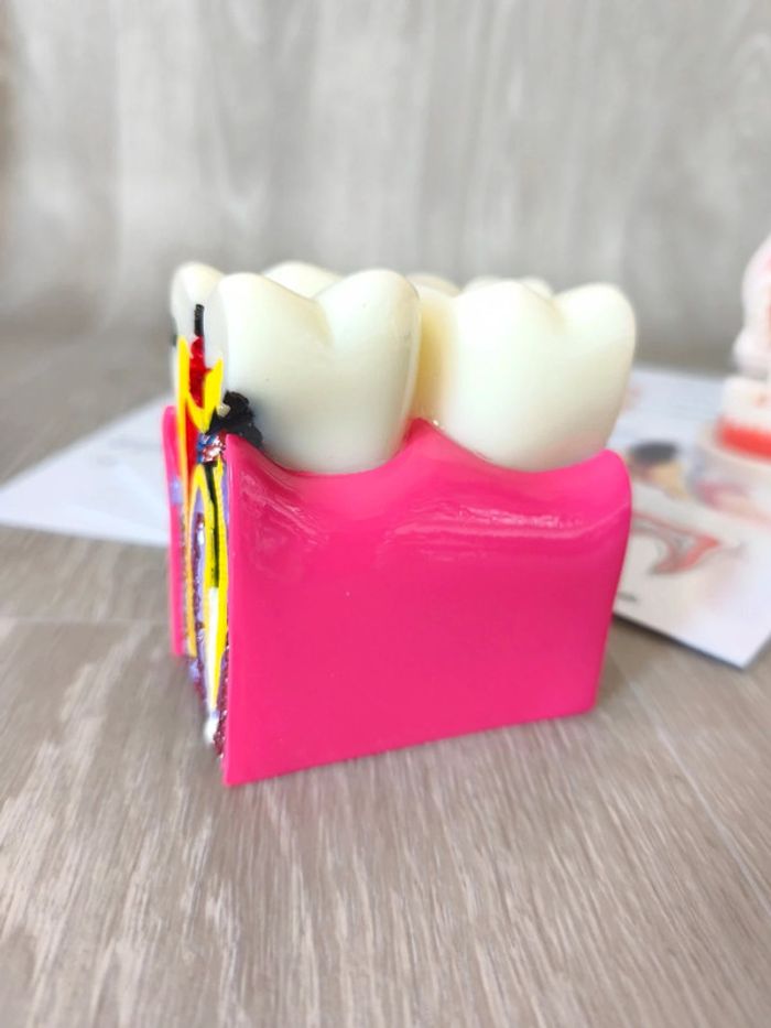 Kit anatomie de la dent saine et la dent cariée - photo numéro 4