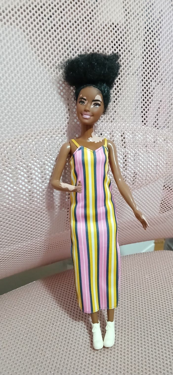Barbie vitiligo