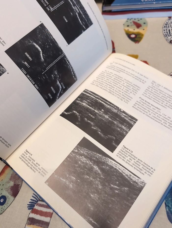Échographie en pathologie musculaire et tendineuse - photo numéro 5