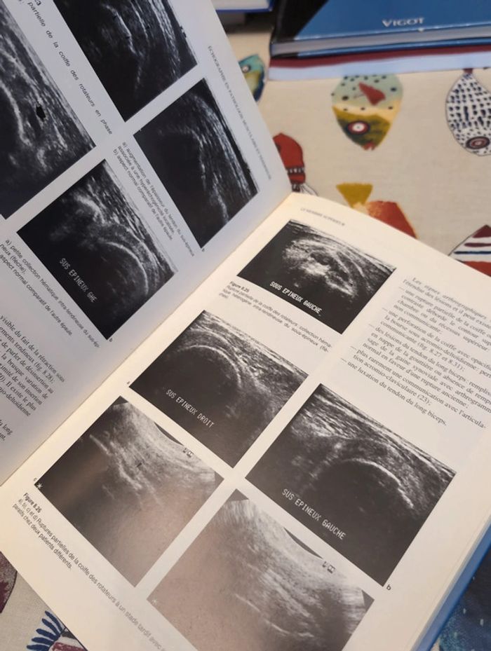 Échographie en pathologie musculaire et tendineuse - photo numéro 4