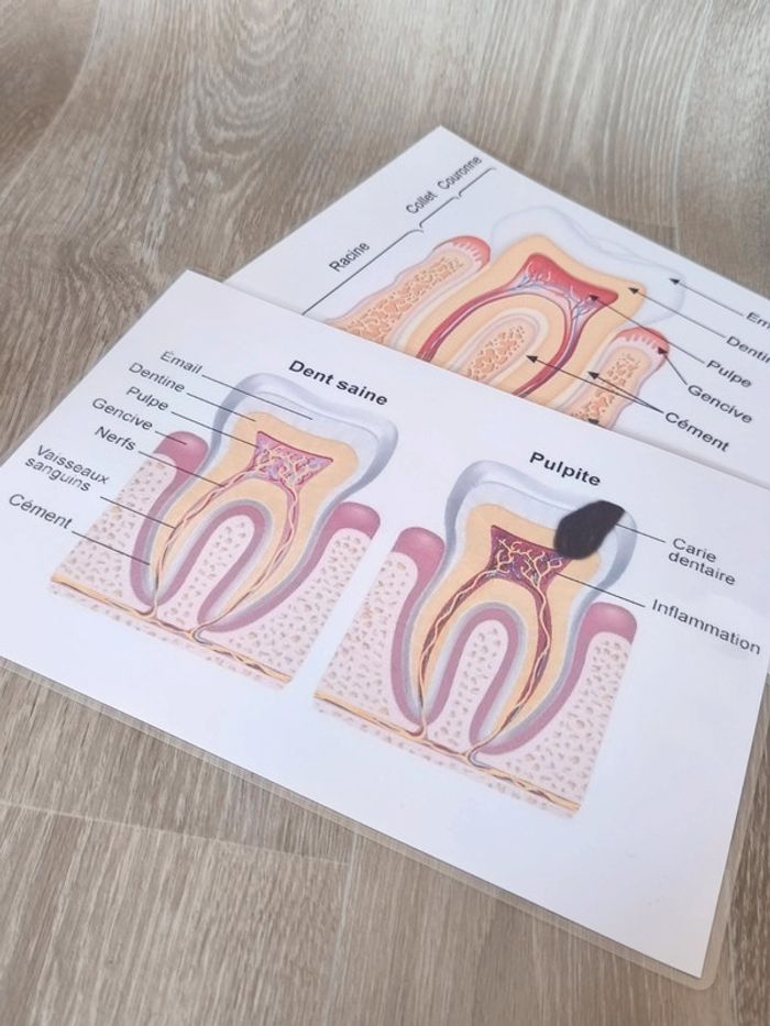 Kit anatomie de la dent saine et la dent cariée - photo numéro 9