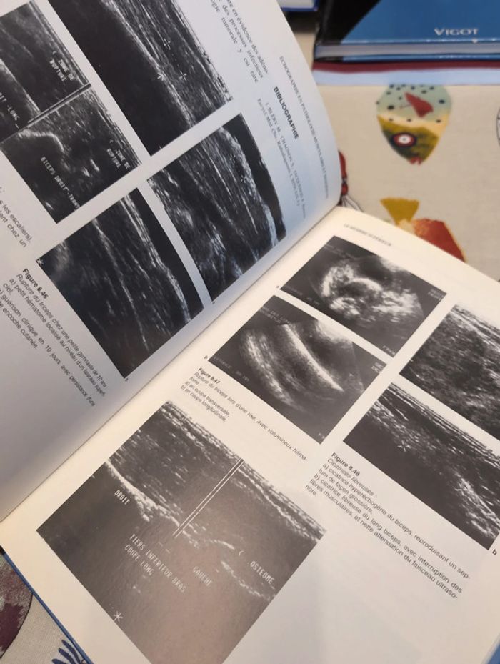 Échographie en pathologie musculaire et tendineuse - photo numéro 3
