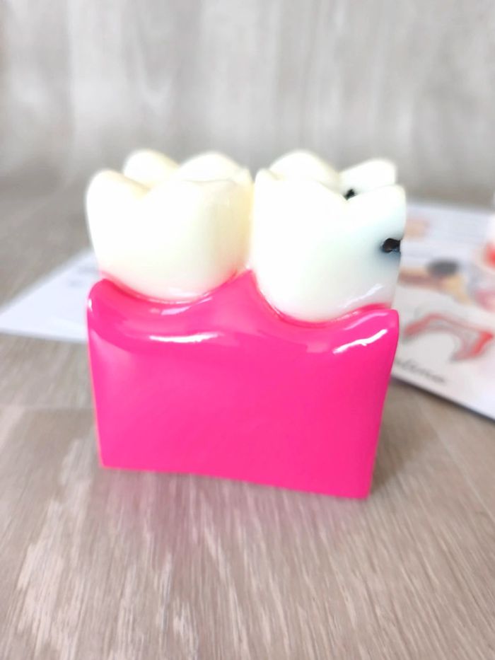 Kit anatomie de la dent saine et la dent cariée - photo numéro 3